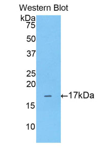 DAB staining on IHC-P; Samples: Human Breast cancer Tissue; Primary Ab: 20µg/ml Rabbit Anti-Rat ANXA3 Antibody Second Ab: 2µg/mL HRP-Linked Caprine Anti-Rabbit IgG Polyclonal Antibody