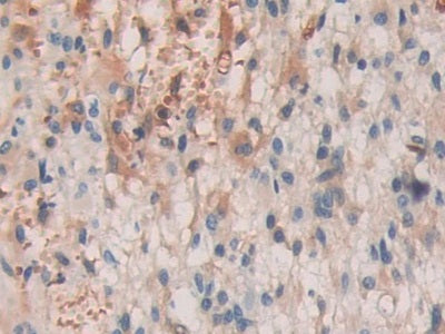 DAB staining on IHC-P; Samples: Human Stomach Cancer Tissue.