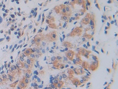 DAB staining on IHC-P; Samples: Human Stomach Cancer Tissue.