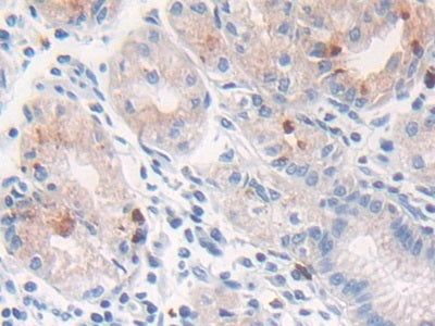 DAB staining on IHC-P; Samples: Human Lung Cancer Tissue.