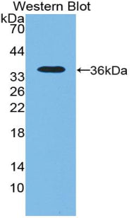 DAB staining on IHC-P; Samples: Human Prostate cancer Tissue; Primary Ab: 10µg/ml Rabbit Anti-Human NT5C3 Antibody Second Ab: 2µg/mL HRP-Linked Caprine Anti-Rabbit IgG Polyclonal Antibody