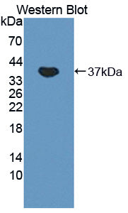DAB staining on IHC-P; Samples: Human Colorectal cancer Tissue; Primary Ab: 30µg/ml Rabbit Anti-Human OAT Antibody Second Ab: 2µg/mL HRP-Linked Caprine Anti-Rabbit IgG Polyclonal Antibody