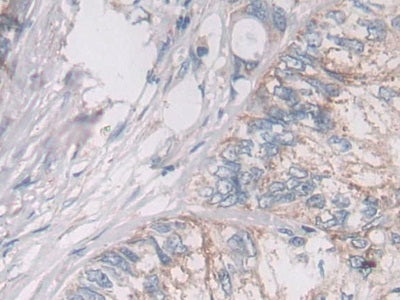 DAB staining on IHC-P; Samples：Human Rectum Cancer Tissue.