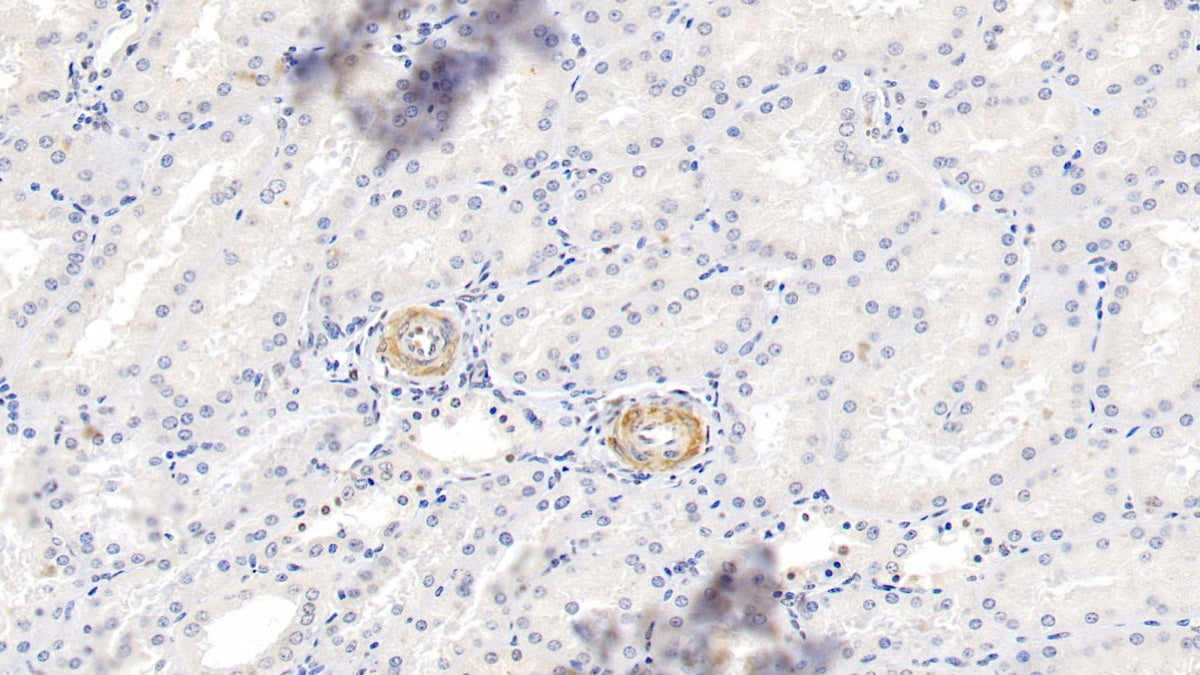 DAB staining on fromalin fixed paraffin- embedded breast tissue)