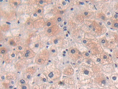 DAB staining on IHC-P; Samples: Human Rectum Cancer Tissue.
