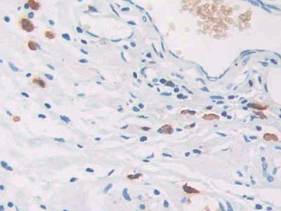 DAB staining on fromalin fixed paraffin- embedded stomach cancer tissue)