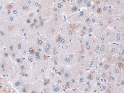 DAB staining on IHC-P; Samples: Human Glioma Tissue.