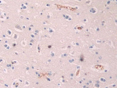 DAB staining on fromalin fixed paraffin- embedded stomach cancer tissue)