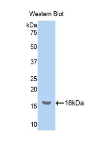 DAB staining on IHC-P; Samples: Human Colorectal cancer Tissue; Primary Ab: 20μg/ml Rabbit Anti-Human NPM Antibody Second Ab: 2µg/mL HRP-Linked Caprine Anti-Rabbit IgG Polyclonal Antibody