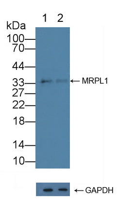 DAB staining on IHC-P; Samples: Human Lung cancer Tissue; Primary Ab: 20µg/ml Rabbit Anti-Human MRPL1 Antibody Second Ab: 2µg/mL HRP-Linked Caprine Anti-Rabbit IgG Polyclonal Antibody