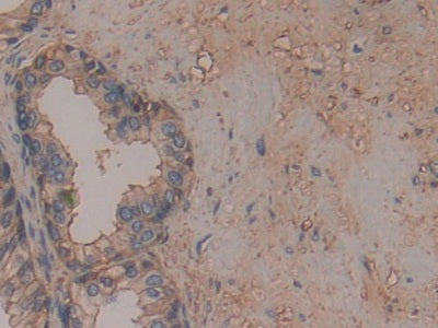 DAB staining on IHC-P; Samples: Human Glioma Tissue.
