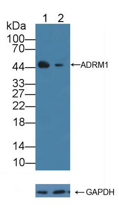 DAB staining on IHC-P; Samples: Human Skin cancer Tissue; Primary Ab: 10µg/ml Rabbit Anti-Human ADRM1 Antibody Second Ab: 2µg/mL HRP-Linked Caprine Anti-Rabbit IgG Polyclonal Antibody
