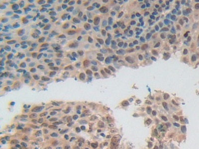 DAB staining on IHC-P; Samples：Human Breast Cancer Tissue.