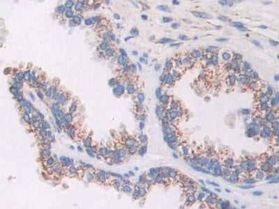 DAB staining on IHC-P; Samples: Human Glioma Tissue