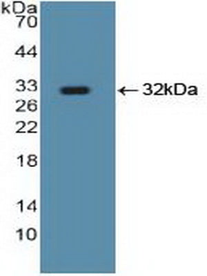 DAB staining on IHC-P; Samples: Human Liver cancer Tissue; Primary Ab: 10µg/ml Rabbit Anti-Human Smad5 Antibody Second Ab: 2µg/mL HRP-Linked Caprine Anti-Rabbit IgG Polyclonal Antibody
