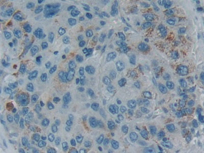 DAB staining on IHC-P; Samples: Human Rectum CancerTissue.