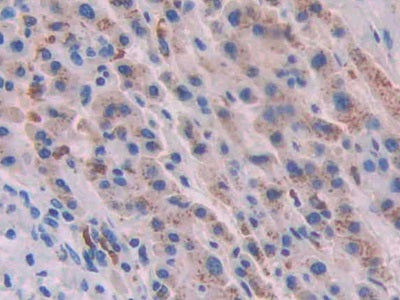 DAB staining on IHC-P; Samples: Human Liver Cancer Tissue