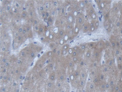 DAB staining on IHC-P; Samples: Human Liver Cancer Tissue.