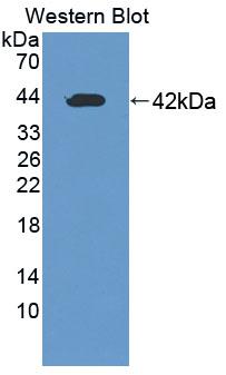 DAB staining on IHC-P; Samples: Human Breast Cancer Tissue; Primary Ab: 10µg/ml Rabbit Anti-Human EGFR2 Antibody Second Ab: 2µg/mL HRP-Linked Caprine Anti-Rabbit IgG Polyclonal Antibody