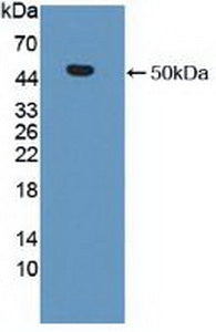 DAB staining on IHC-P; Samples: Human Prostate cancer Tissue; Primary Ab: 10µg/ml Rabbit Anti-Human MMP19 Antibody Second Ab: 2µg/mL HRP-Linked Caprine Anti-Rabbit IgG Polyclonal Antibody