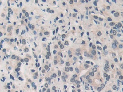 DAB staining on IHC-P; Samples: Human Lung Cancer Tissue.