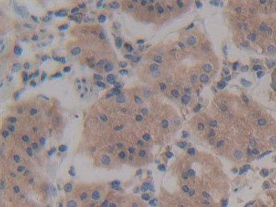 DAB staining on IHC-P; Samples: Human Breast Cancer Tissue.