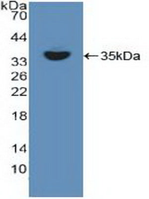 DAB staining on IHC-P; Samples: Human Liver cancer Tissue;  Primary Ab: 10µg/ml Rabbit Anti-Human RE