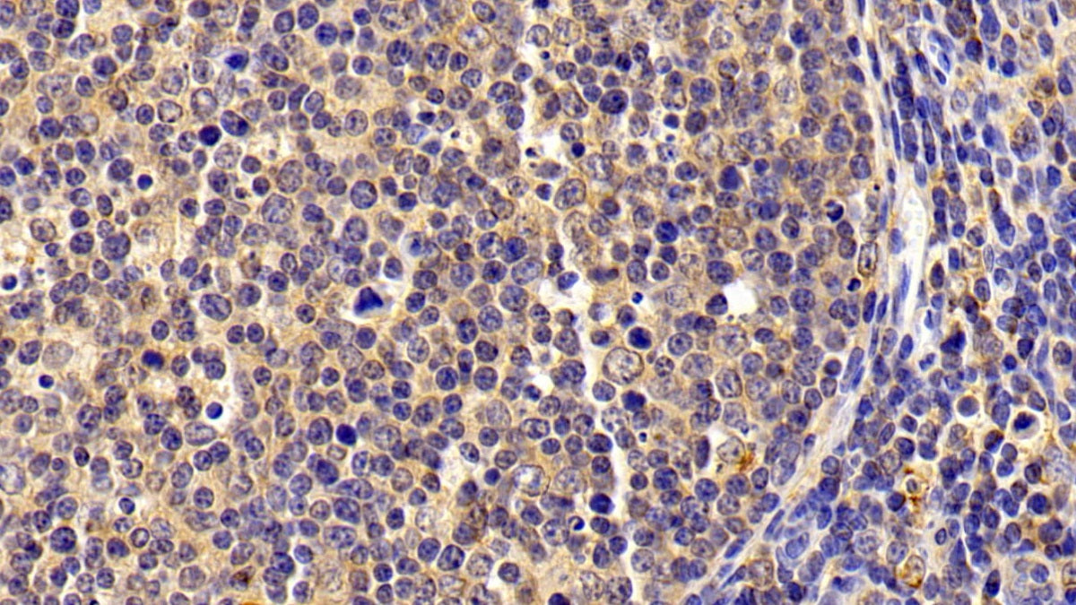 DAB staining on IHC-P; Samples: Porcine Spleen Tissue;  Primary Ab: 10μg/ml Rabbit Anti-Porcine S100A8 Antibody Second Ab: 2µg/mL HRP-Linked Caprine Anti-Rabbit IgG Polyclonal Antibody