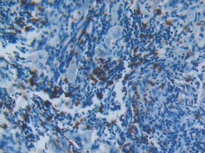 DAB staining on IHC-P; Samples: Human Esophagus Cancer Tissue.