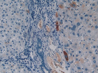 DAB staining on IHC-P; Samples: Human Breast Cancer Tissue