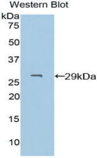DAB staining on IHC-P; Samples: Human Skin cancer Tissue; Primary Ab: 10µg/ml Rabbit Anti-Human PDXK Antibody Second Ab: 2µg/mL HRP-Linked Caprine Anti-Rabbit IgG Polyclonal Antibody