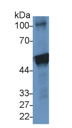 DAB staining on IHC-P; Samples: Human Breast cancer Tissue; Primary Ab: 10ug/ml Rabbit Anti-Human KRT10 Antibody Second Ab: 2µg/mL HRP-Linked Caprine Anti-Rabbit IgG Polyclonal Antibody