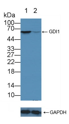 DAB staining on IHC-P; Samples: Human Breast cancer Tissue; Primary Ab: 10µg/ml Rabbit Anti-Human GDI1 Antibody Second Ab: 2µg/mL HRP-Linked Caprine Anti-Rabbit IgG Polyclonal Antibody