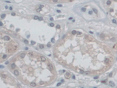DAB staining on IHC-P; Samples: Human Pancreas Cancer Tissue.