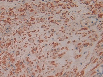 DAB staining on IHC-P; Samples: Human Rectum Cancer Tissue.