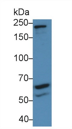 DAB staining on IHC-P; Samples: Human Prostate cancer Tissue; Primary Ab: 10µg/ml Rabbit Anti-Human VEGFR2 Antibody Second Ab: 2µg/mL HRP-Linked Caprine Anti-Rabbit IgG Polyclonal Antibody