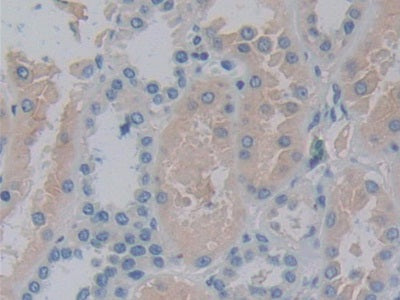 DAB staining on fromalin fixed paraffin- embedded prostate gland cancer tissue)