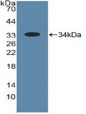 DAB staining on IHC-P; Samples: Human Breast cancer Tissue; Primary Ab: 20µg/ml Rabbit Anti-Human ALOX5 Antibody Second Ab: 2µg/mL HRP-Linked Caprine Anti-Rabbit IgG Polyclonal Antibody