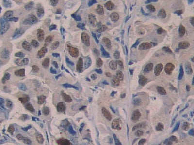 DAB staining on IHC-P; Samples: Human Breast Cancer Tissue.