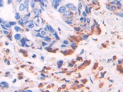 DAB staining on fromalin fixed paraffin- embedded breast cancer tissue)