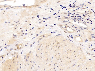 DAB staining on IHC-P; Samples: Human Ovarian cancer Tissue; Primary Ab: 10ug/ml Rabbit Anti-Human AR Antibody Second Ab: 2µg/mL HRP-Linked Caprine Anti-Rabbit IgG Polyclonal Antibody
