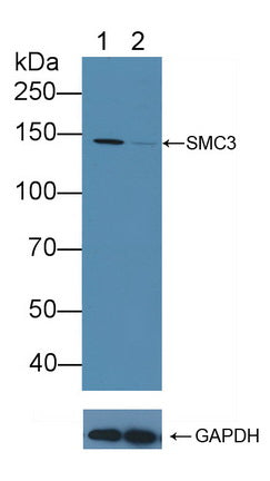 DAB staining on IHC-P; Samples: Human Stomach cancer Tissue; Primary Ab: 10µg/ml Rabbit Anti-Human SMC3 Antibody Second Ab: 2µg/mL HRP-Linked Caprine Anti-Rabbit IgG Polyclonal Antibody