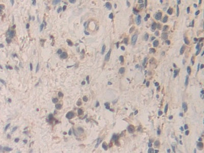 DAB staining on IHC-P; Samples: Human Stomach Cancer Tissue.