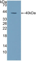 DAB staining on IHC-P; Samples: Human Prostate cancer Tissue; Primary Ab: 10µg/ml Rabbit Anti-Human ALPL Antibody Second Ab: 2µg/mL HRP-Linked Caprine Anti-Rabbit IgG Polyclonal Antibody