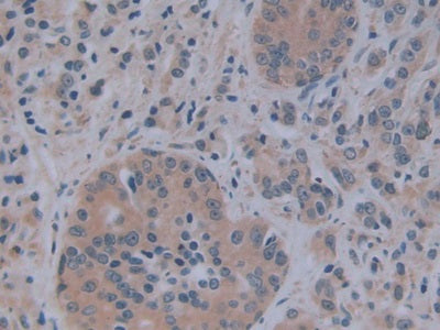 DAB staining on IHC-P; Samples: Human Breast Cancer Tissue.