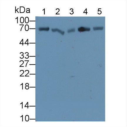 DAB staining on IHC-P; Samples: Human Breast cancer Tissue; Primary Ab: 20µg/ml Rabbit Anti-Human HSPA1A Antibody Second Ab: 2µg/mL HRP-Linked Caprine Anti-Rabbit IgG Polyclonal Antibody
