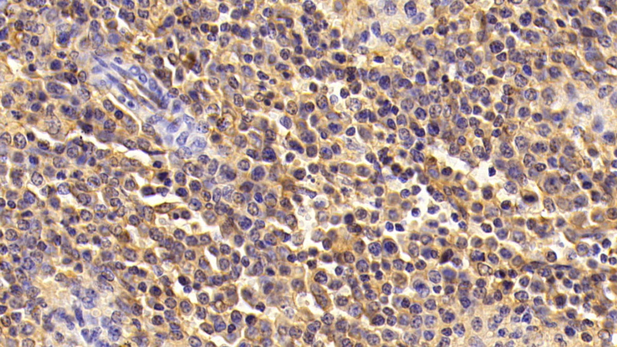 DAB staining on IHC-P; Samples: Porcine Liver Tissue; Primary Ab: 10μg/ml Rabbit Anti-Porcine ALB Antibody Second Ab: 2µg/mL HRP-Linked Caprine Anti-Rabbit IgG Polyclonal Antibody