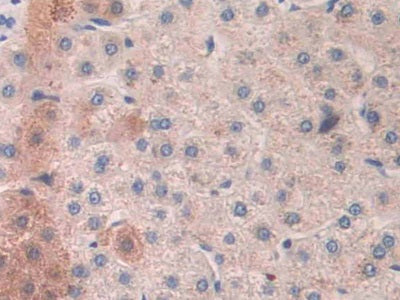 DAB staining on IHC-P; Samples: Human Liver Cancer Tissue