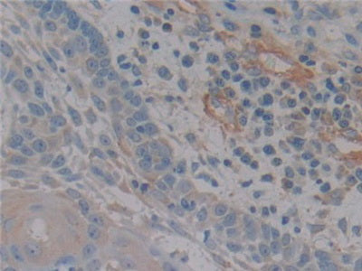 DAB staining on fromalin fixed paraffin- embedded breast cancer tissue)