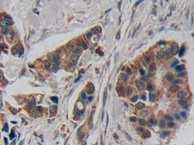 DAB staining on IHC-P; Samples: Human Prostate cancer Tissue; Primary Ab: 10µg/ml Rabbit Anti-Human CRH Antibody Second Ab: 2µg/mL HRP-Linked Caprine Anti-Rabbit IgG Polyclonal Antibody